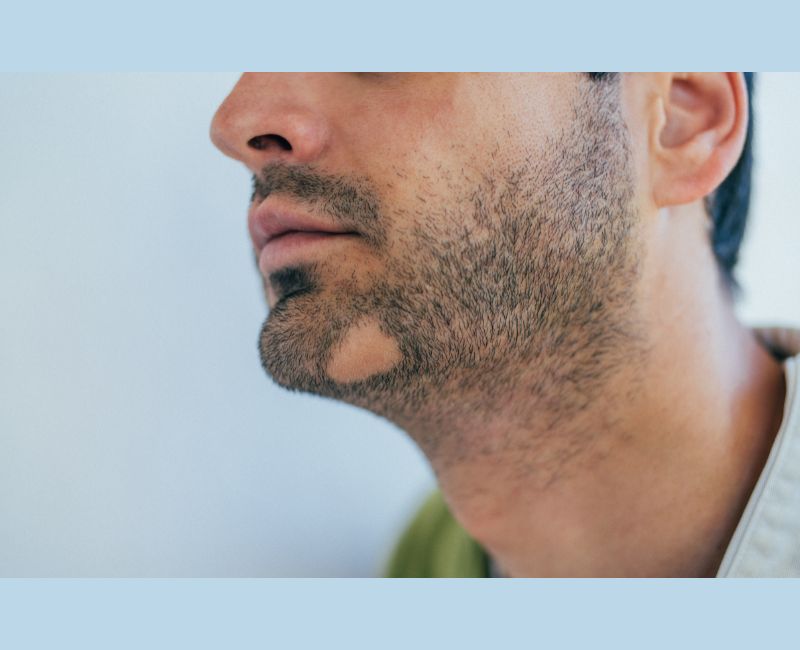 Risks of Beard Transplant - VizoxClinique
