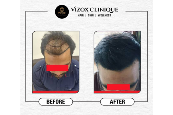 Hair Transplant - Vizox Clinique