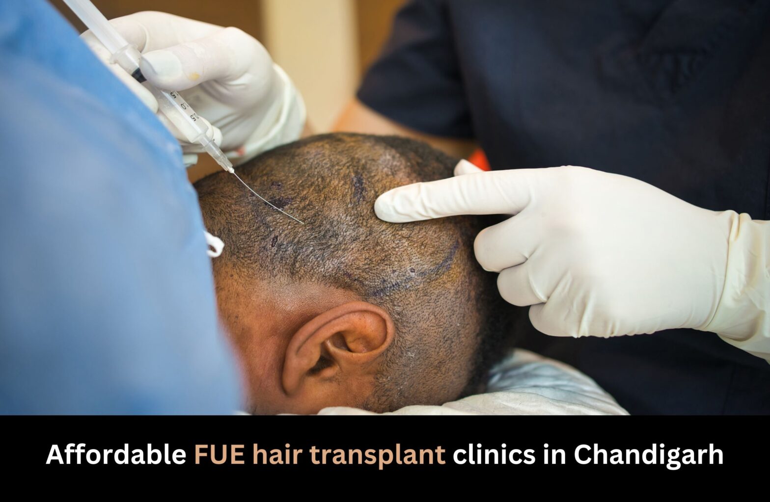 Affordable FUE hair transplant clinics in Chandigarh