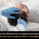 Best Hair transplant Clinic in Chandigarh