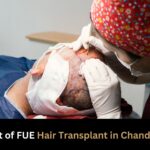 Cost of FUE hair transplant in Chandigarh