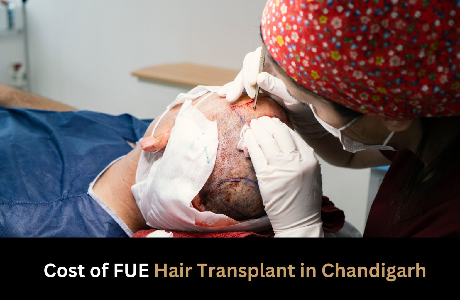 Cost of FUE hair transplant in Chandigarh