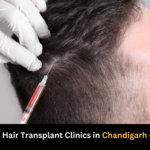 Best Hair transplant Hospital in Chandigarh